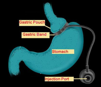 Gastric Banding (LAGB)