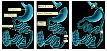 Roux-en-Y Gastric Bypass (LRYGB)