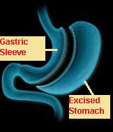 Sleeve Gastrectomy (LSG)